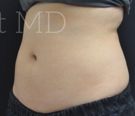 After Image: Abdomen - left-front-oblique