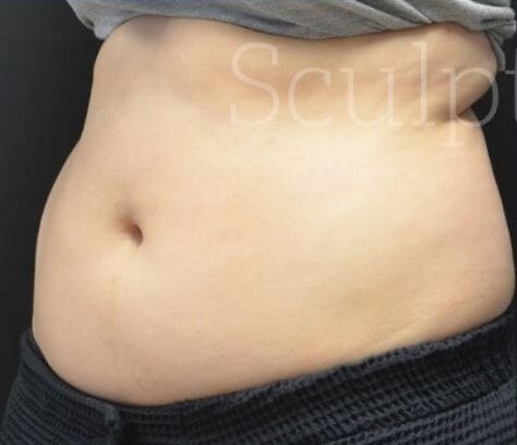 Before Image: Abdomen - left-front-oblique