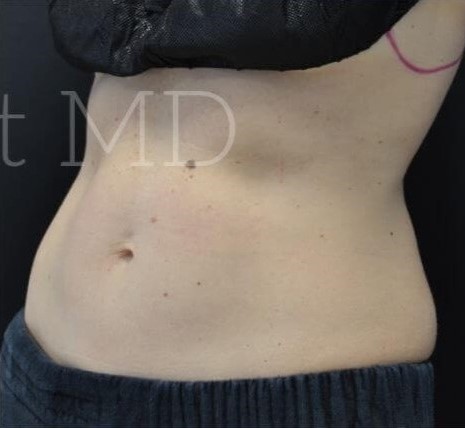 After Image: Abdomen - left-front-oblique