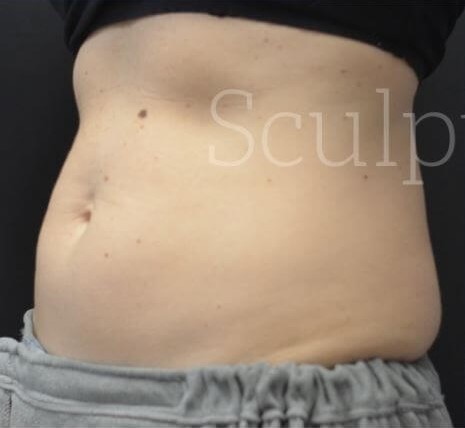 Before Image: Abdomen - left-front-oblique
