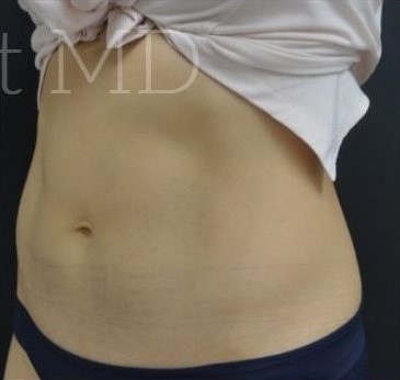 After Image: Abdomen - left-front-oblique
