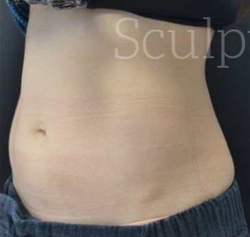 Before Image: Abdomen - left-front-oblique