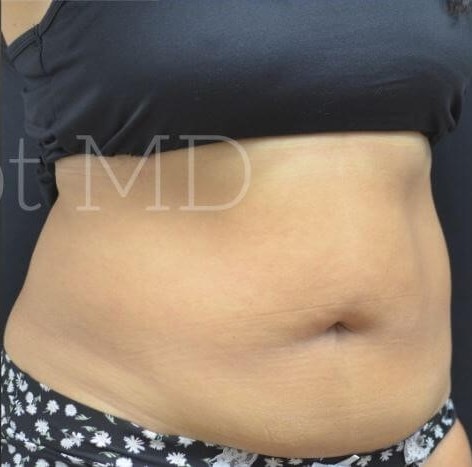 After Image: Abdomen - right-front-oblique