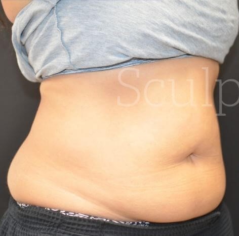 Before Image: Abdomen - right-front-oblique