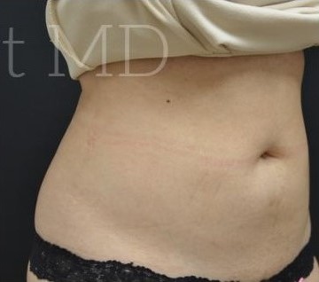 After Image: Abdomen - right-front-oblique