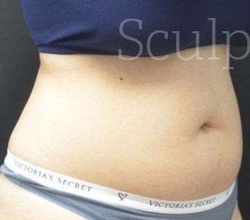 Before Image: Abdomen - right-front-oblique