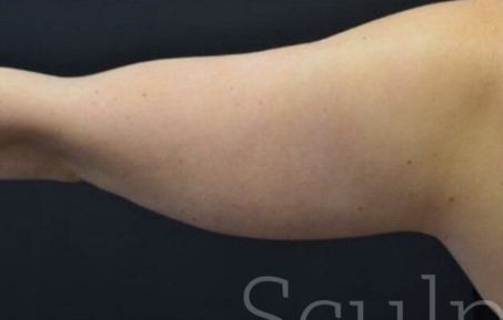 Before Image: Arms - back