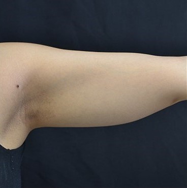 After Image: Arms - front