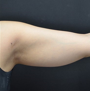 Before Image: Arms - front