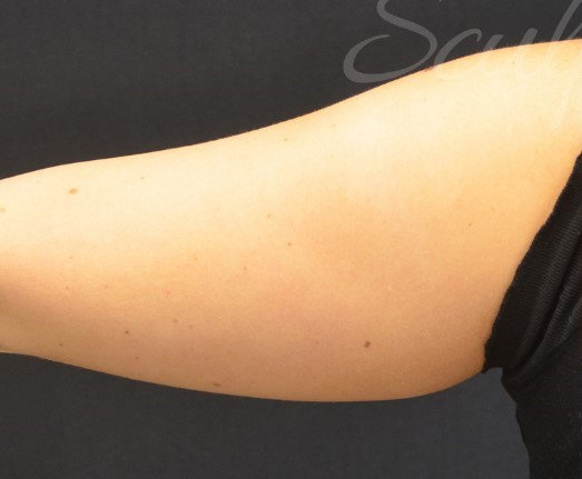 Before Image: Arms - back