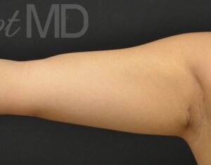 After Image: Arms
