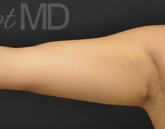 After Image: Arms - front