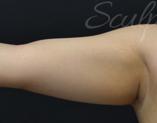 Before Image: Arms - front