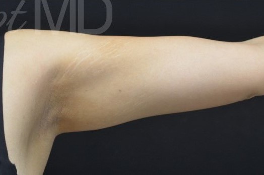 After Image: Arms - front