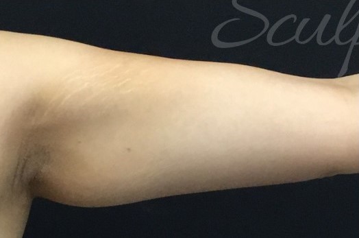 Before Image: Arms - front