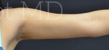 After Image: Arms - front
