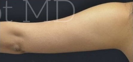 After Image: Arms - right-back-oblique