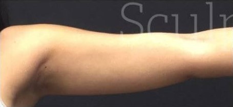 Before Image: Arms - front