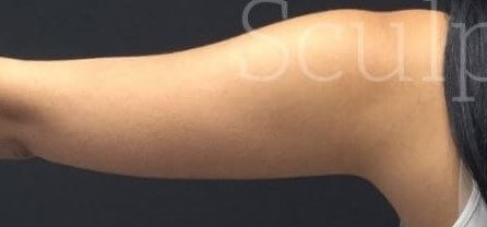 Before Image: Arms - right-back-oblique