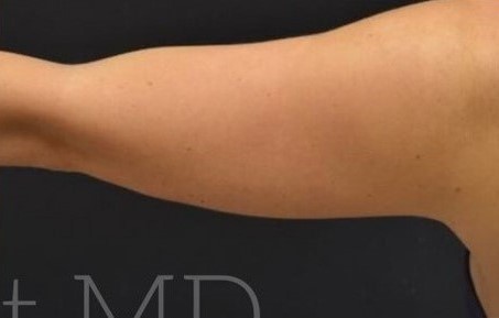 After Image: Arms - back