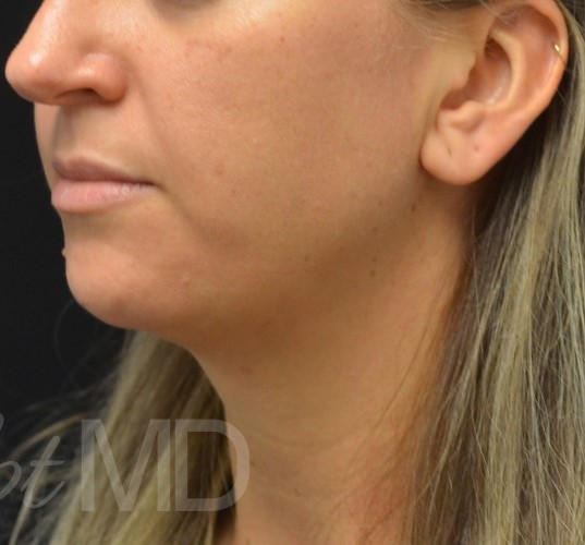 After Image: Chin - left-front-oblique