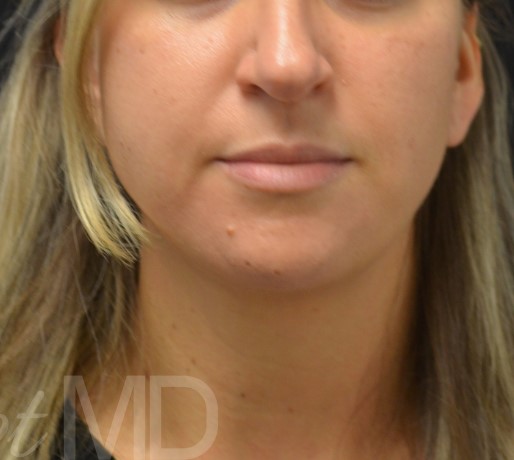 After Image: Chin - front