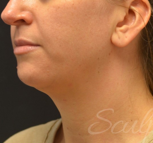 Before Image: Chin - left-front-oblique
