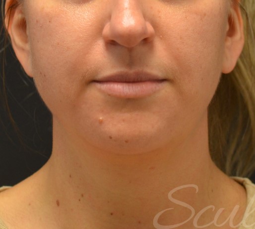 Before Image: Chin - front