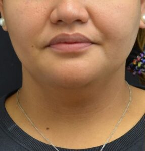Before Image: Chin