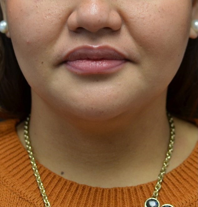 After Image: Chin - front