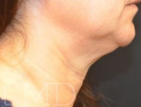 After Image: Chin - right-side