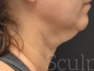 Before Image: Chin