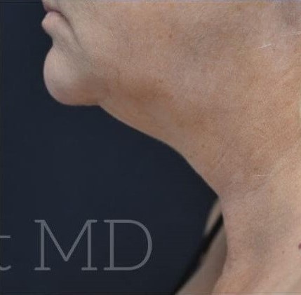 After Image: Chin - left-side