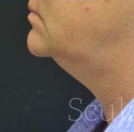 Before Image: Chin - left-side