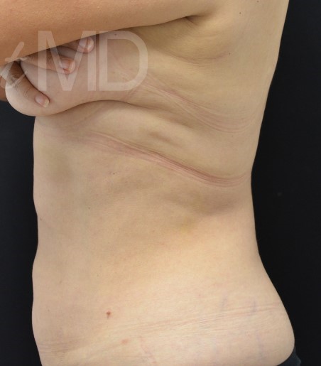After Image: Flanks - left-side