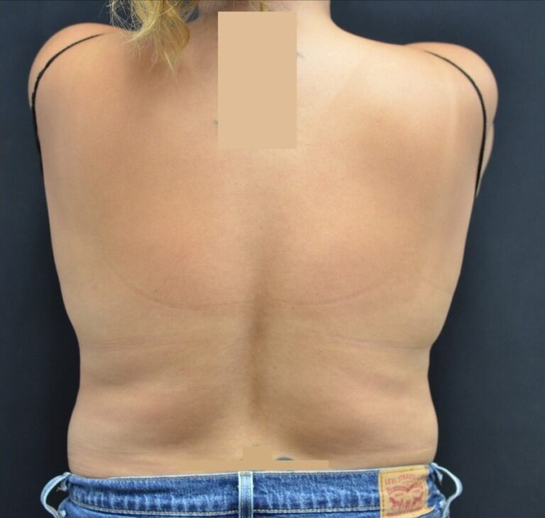 After Image: Flanks - back