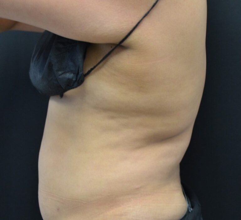 Before Image: Flanks - left-side
