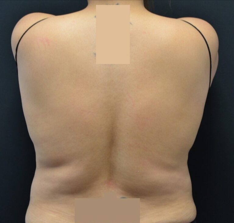 Before Image: Flanks - back