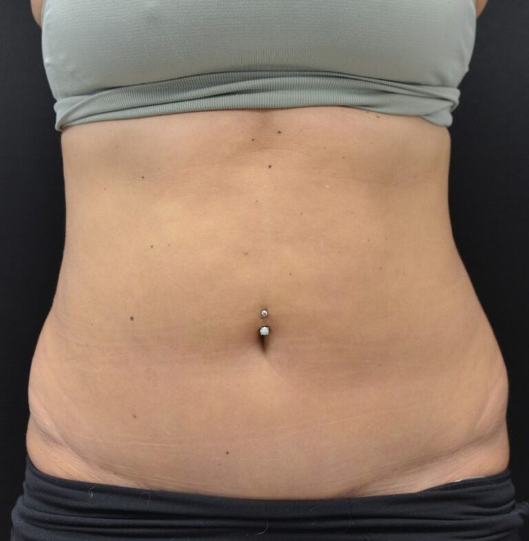 Before Image: Flanks - front