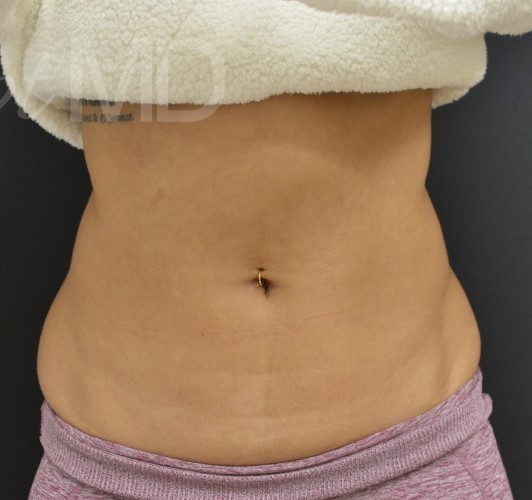 After Image: Flanks - front
