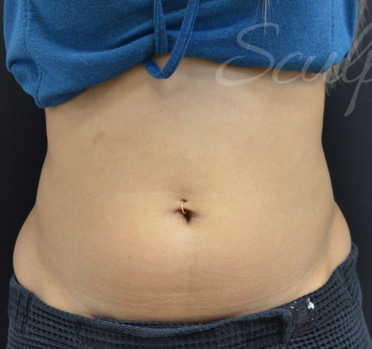 Before Image: Flanks - front