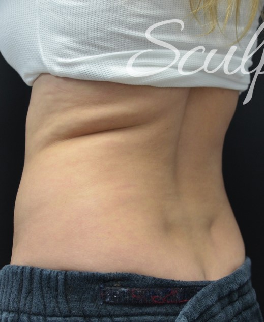 Before Image: Flanks - left-back-oblique