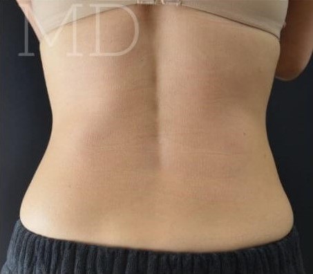 After Image: Flanks - back