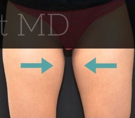 After Image: Inner-thighs - front