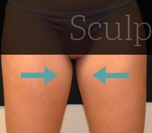 Before Image: Inner-thighs