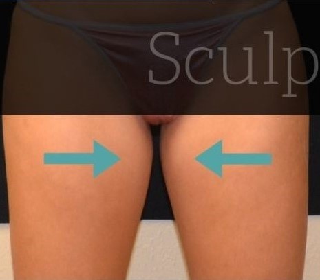 Before Image: Inner-thighs - front