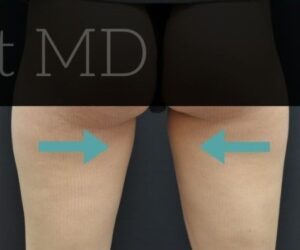 After Image: Inner-thighs