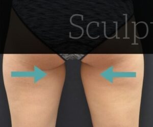 Before Image: Inner-thighs