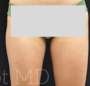 After Image: Inner-thighs