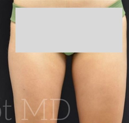 After Image: Inner-thighs - front